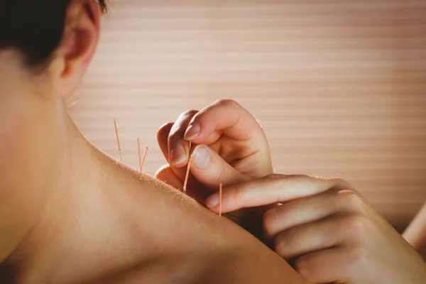 young-woman-getting-acupuncture-treatment-in-thera-2021-08-28-16-11-05-utc